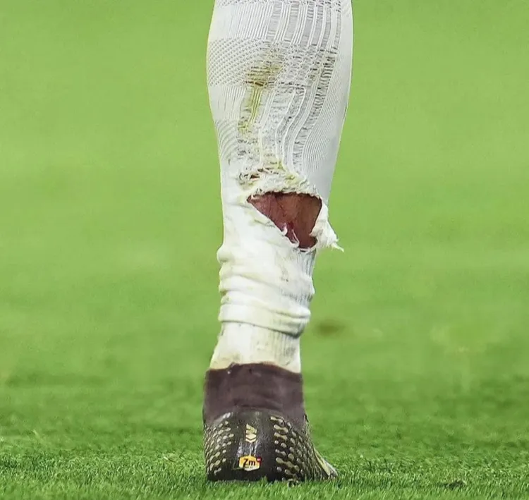 Tak wyglądała noga Mbappe po starciu z Tahem